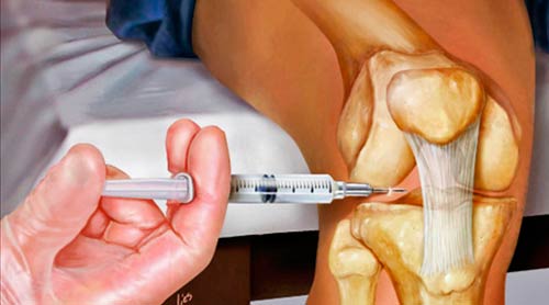 внутрисуставные инъекции